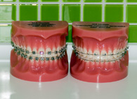 Bild på tandställning